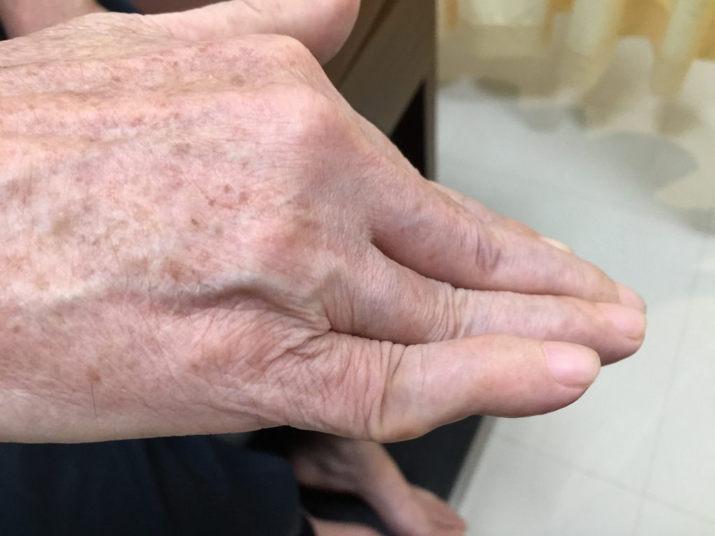  www.DoterRematikAutoimun - Rheumatoid artritis pada tahap lanjut