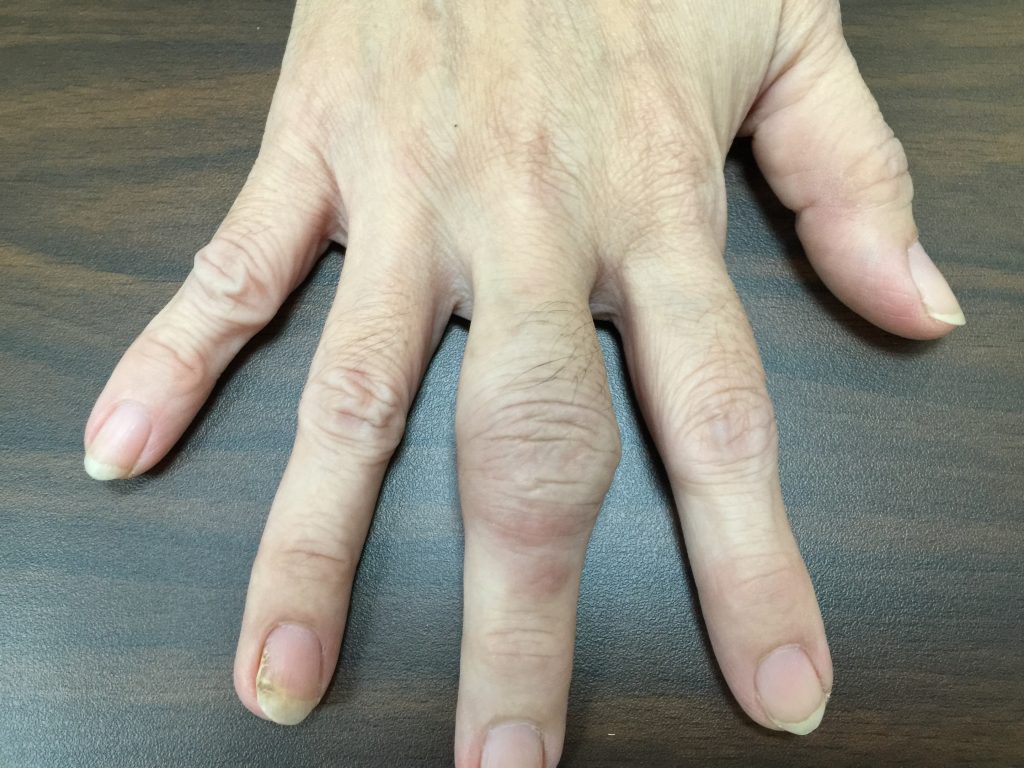 www.DoterRematikAutoimun - Rheumatoid artritis pada tahap awal