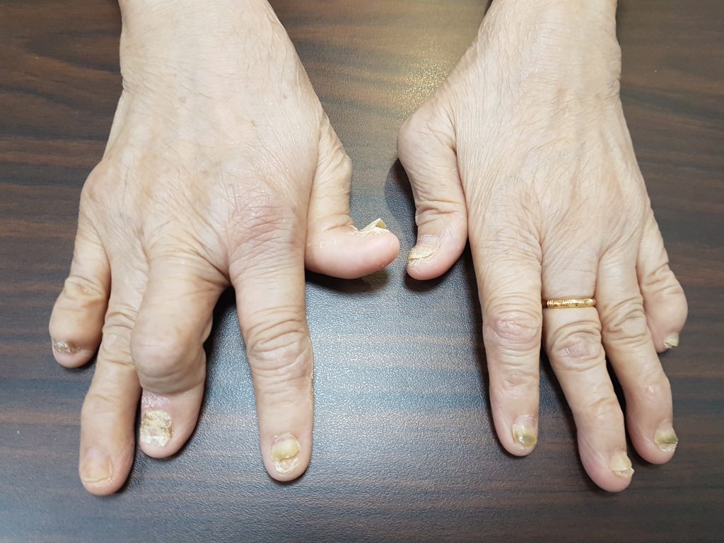 www.DokterRematikAutoimun.com - psoriatic artritis 1