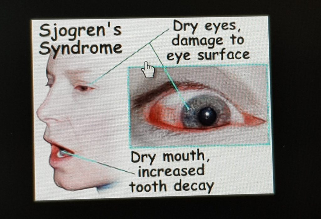 www.DokterRematikAutoimun - Sjogren's Syndrome