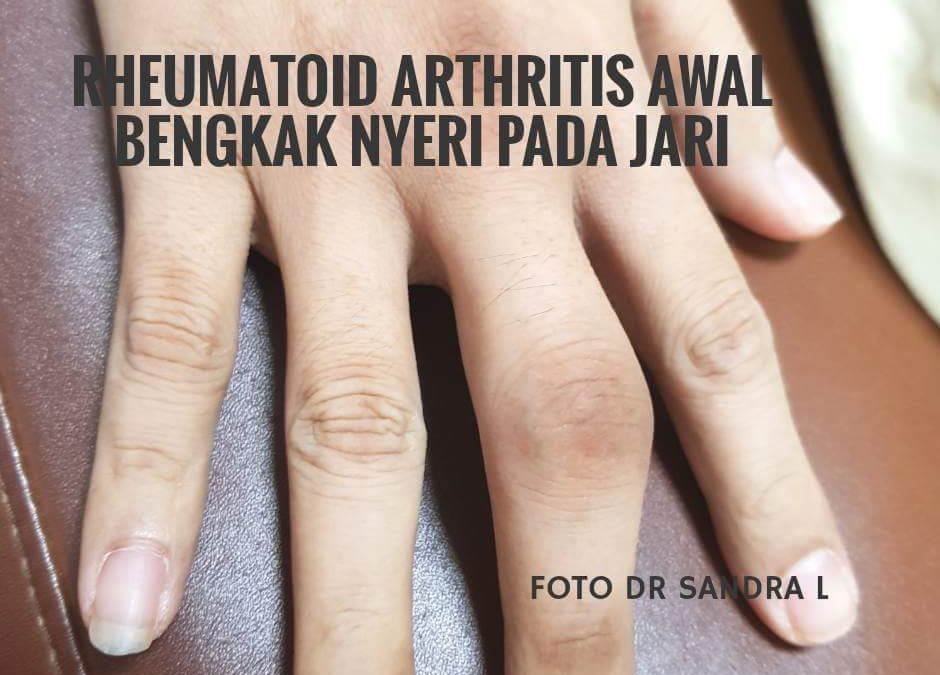 Hamil dengan Rheumatoid Artritis, Apa Mungkin?