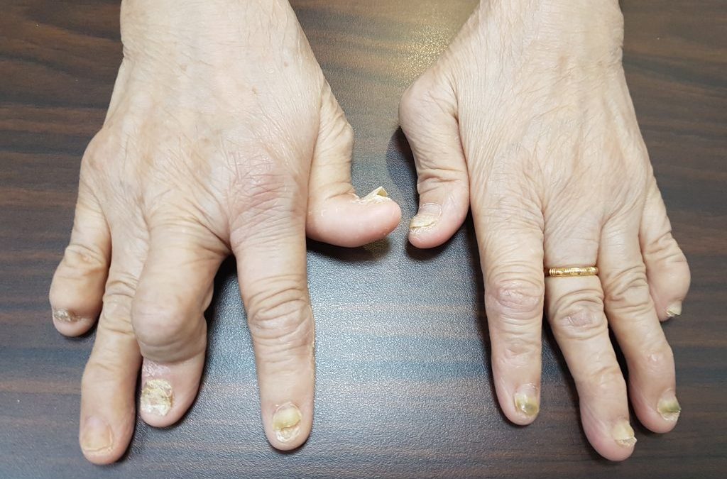 Artritis Psoriatik, Ketika Kulit dan Sendi Menjadi Sahabat