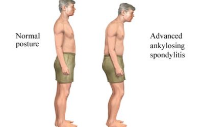 Lebih Mengenal Gejala Ankylosing Spondylitis